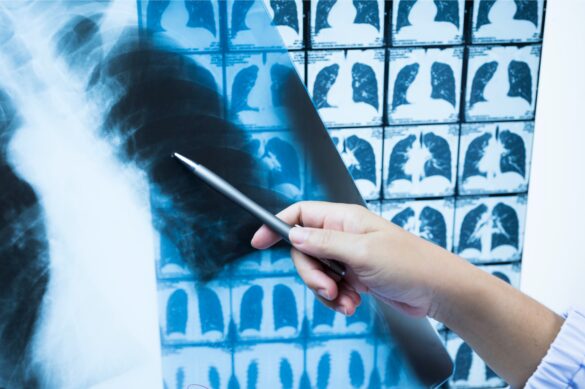 rayos x e inteligencia artificial para evitar falsos negativos en el diagnostico de la covid 19