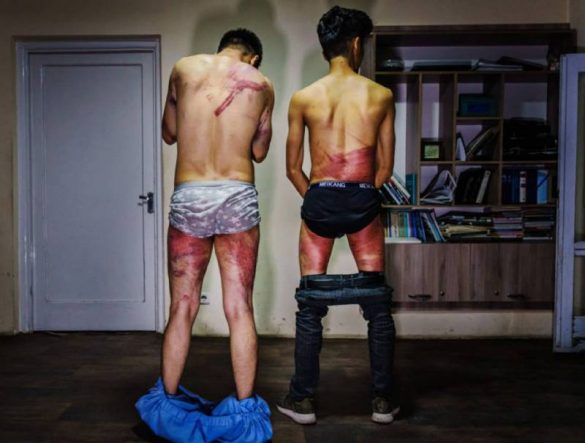 Los periodistas de 'Etilaatroz' Nemat Naqdi (28) y Taqi Daryabi (22) muestran su cuerpo tras la paliza propinada por los talibanes. / MARCUS YAM / LOS ANGELES TIMES (GETTY)